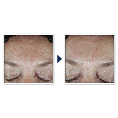 RoC Multi Correxion Hydrate + Plump Daily Moisturizer With Hyaluronic Acid - SPF 30 - 1.7oz 11 RoC Multi Correxion Hydrate + Plump Daily Moisturizer With Hyaluronic Acid - SPF 30 - 1.7oz - Image 9