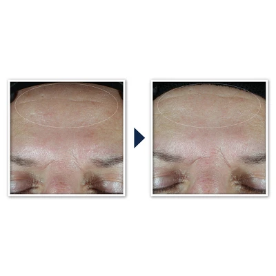 RoC Multi Correxion Hydrate + Plump Daily Moisturizer With Hyaluronic Acid - SPF 30 - 1.7oz 10 RoC Multi Correxion Hydrate + Plump Daily Moisturizer With Hyaluronic Acid - SPF 30 - 1.7oz - Image 8