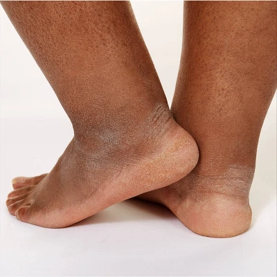 CeraVe Healing Ointment Skin Protectant, Soothes Dry, Cracked And Chafed Skin, Non-Greasy Unscented - 12oz 8 CeraVe Healing Ointment Skin Protectant, Soothes Dry, Cracked And Chafed Skin, Non-Greasy Unscented - 12oz - Image 6