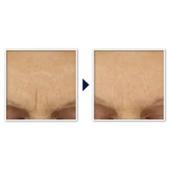 RoC Retinol Correxion Anti-Aging Retinol Moisturizer With Hydrating Hyaluronic Acid - 1.7oz -Serene Skin GUEST 59cb5315 98f7 4071 afb5 1ae9353559e9