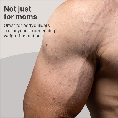 TriLASTIN Stretchmark Prevention Cream, 4oz 6 TriLASTIN Stretchmark Prevention Cream, 4oz - Image 4